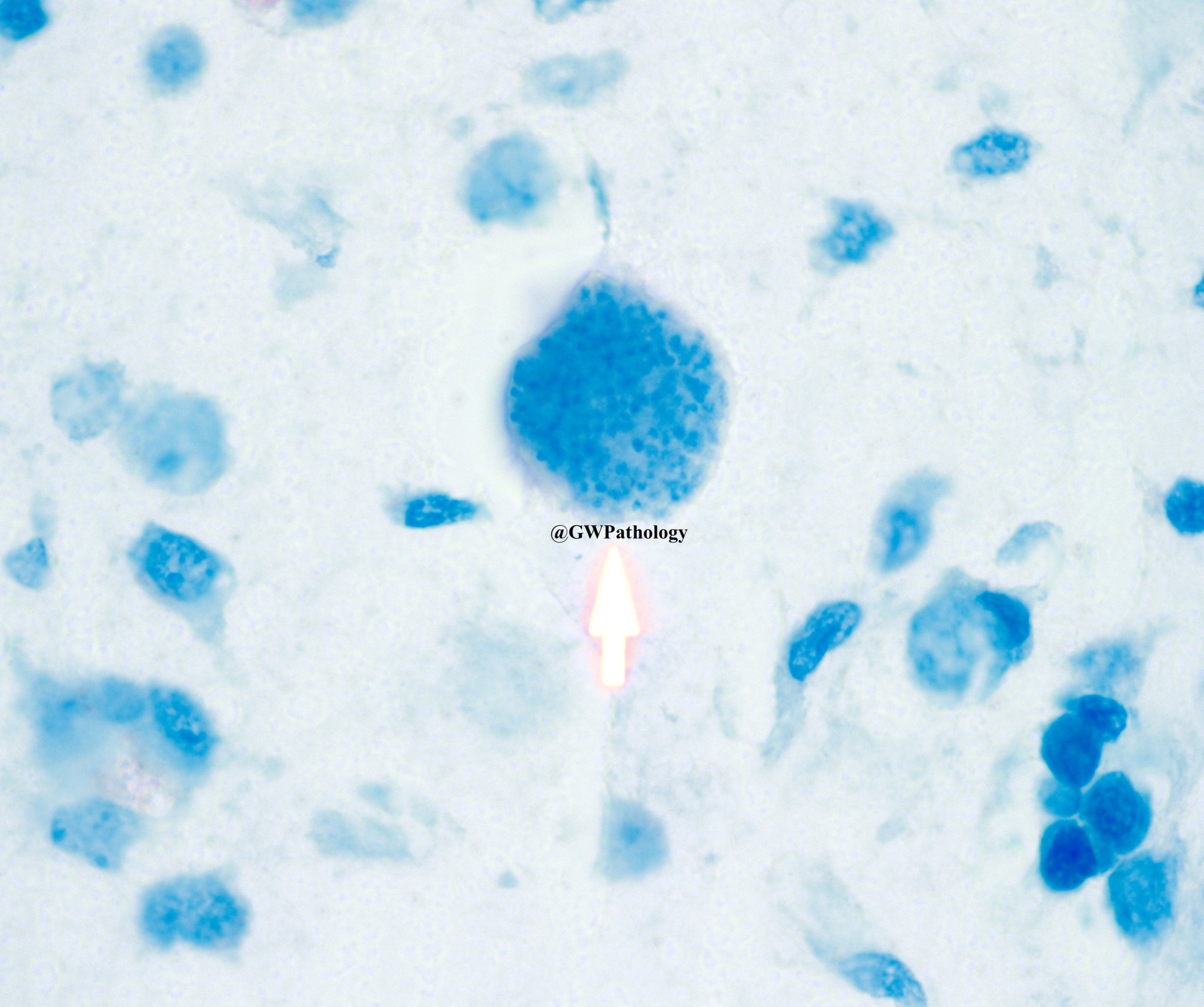 What Is Immunocompromised Patient
