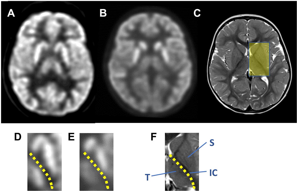 ScienceTM's tweet photo. Dysfunctional inhibitory neurons in the thalamus/sensorimotor cortex of the brain cause #seizures in #G1D disorder, @UTSWNews researchers learn from patient #imaging and mouse studies. https://t.co/b80qFi0BPg https://t.co/jfU9uPMhr3