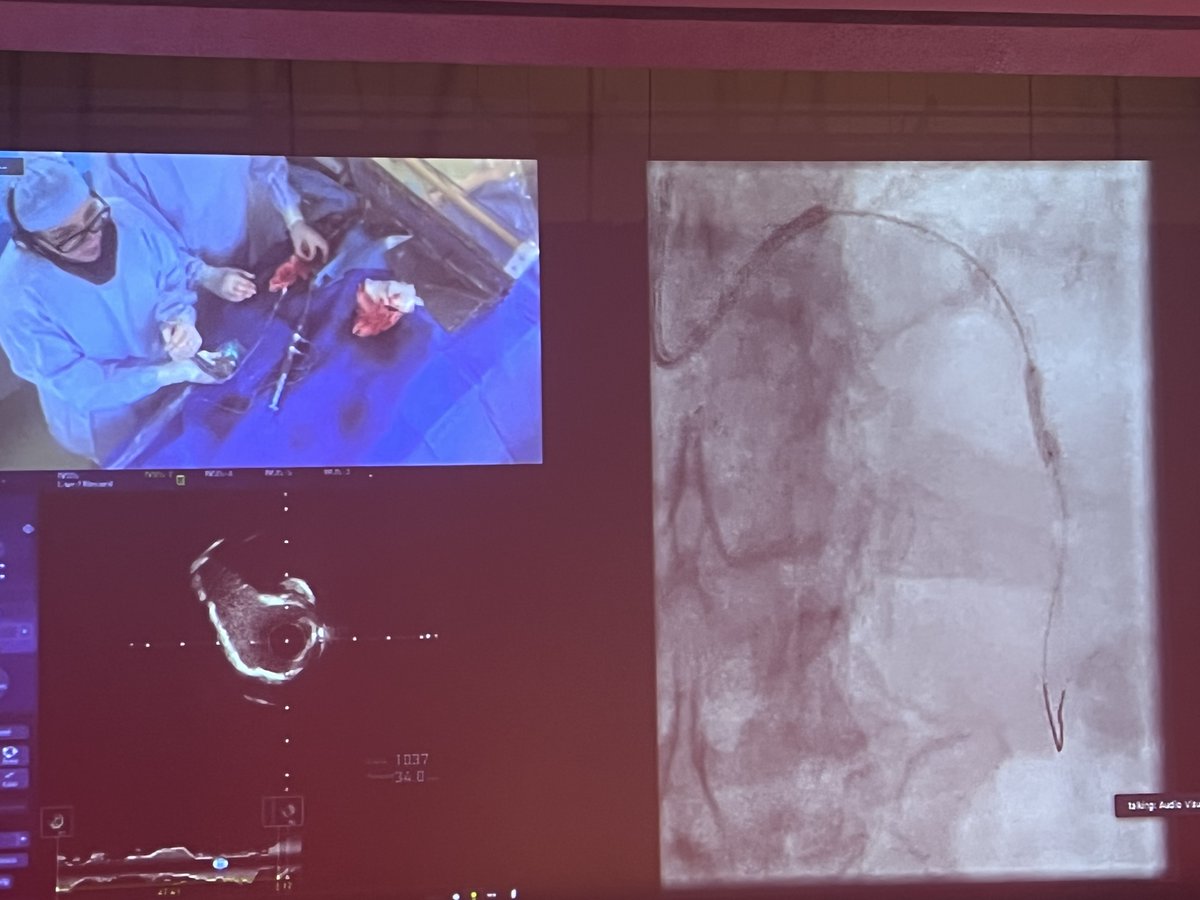 ShockwaveIVL's tweet image. #OPTIMALPCI2022 is off to a brilliant start with this live case by Drs @mbmcentegart @simonjwilson1 @jdinaus utilizing #ShockwaveIVL! Nice #RotaShock strategy with CT planning by Dr @ColletCarlos to evaluate Ca++ in #LAD before procedure.

ISI bit.ly/3iEq7fC @OptimaCTO