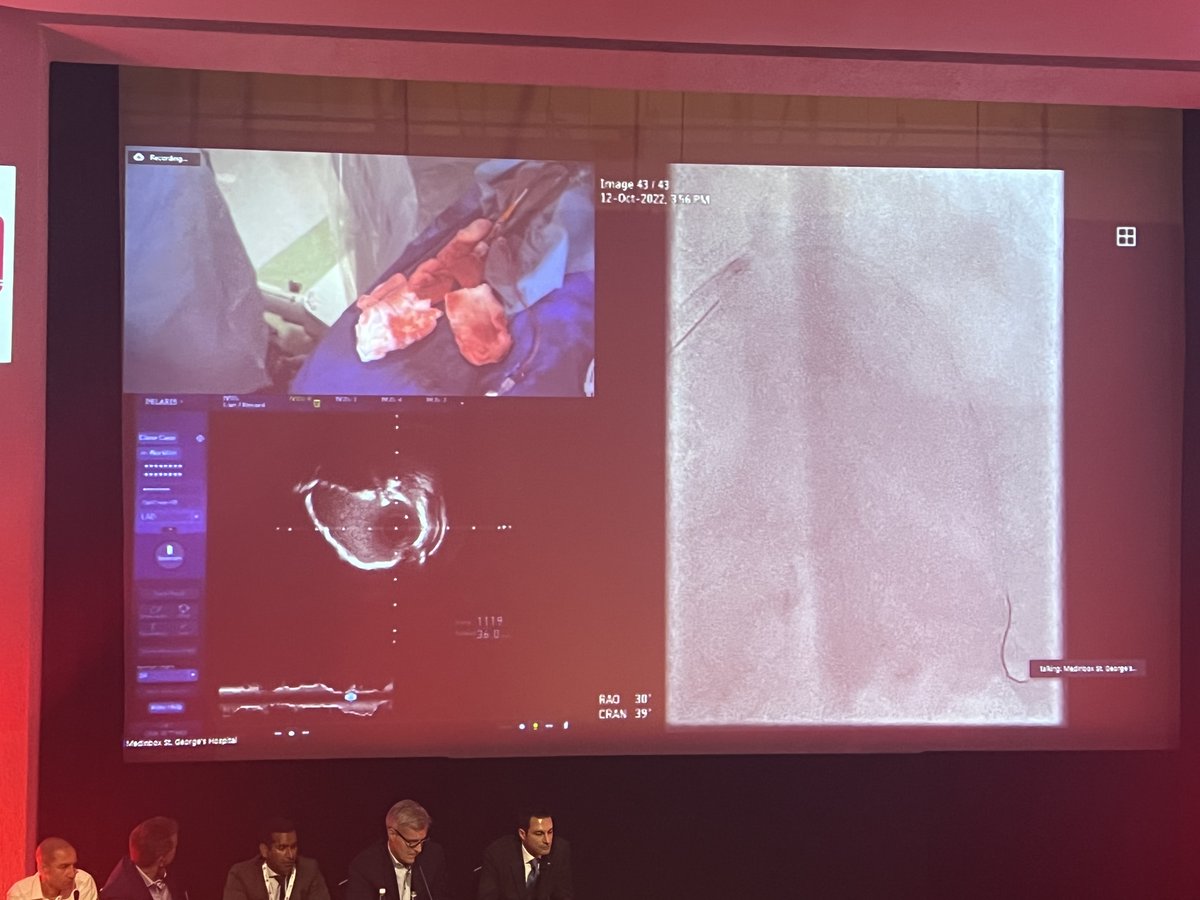 ShockwaveIVL's tweet image. #OPTIMALPCI2022 is off to a brilliant start with this live case by Drs @mbmcentegart @simonjwilson1 @jdinaus utilizing #ShockwaveIVL! Nice #RotaShock strategy with CT planning by Dr @ColletCarlos to evaluate Ca++ in #LAD before procedure.

ISI bit.ly/3iEq7fC @OptimaCTO