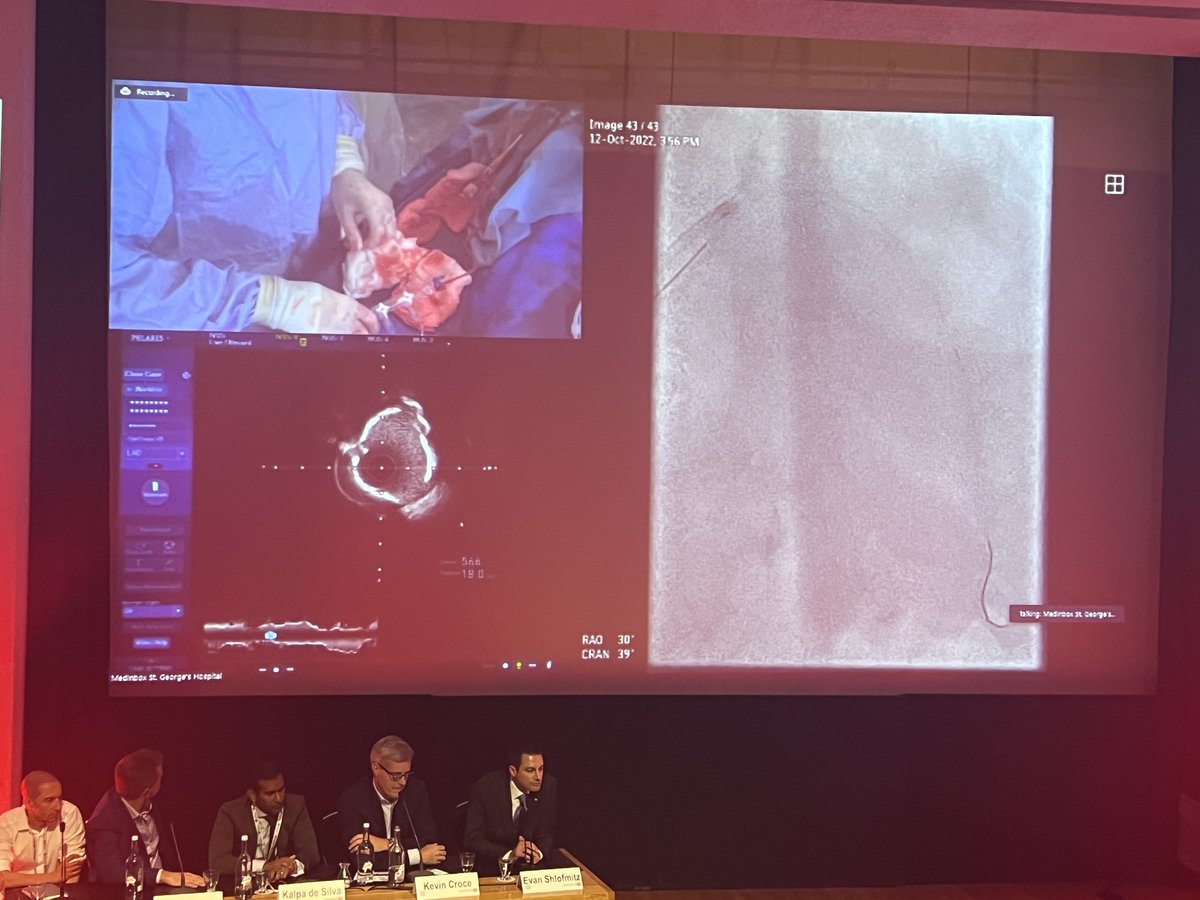 ShockwaveIVL's tweet image. #OPTIMALPCI2022 is off to a brilliant start with this live case by Drs @mbmcentegart @simonjwilson1 @jdinaus utilizing #ShockwaveIVL! Nice #RotaShock strategy with CT planning by Dr @ColletCarlos to evaluate Ca++ in #LAD before procedure.

ISI bit.ly/3iEq7fC @OptimaCTO