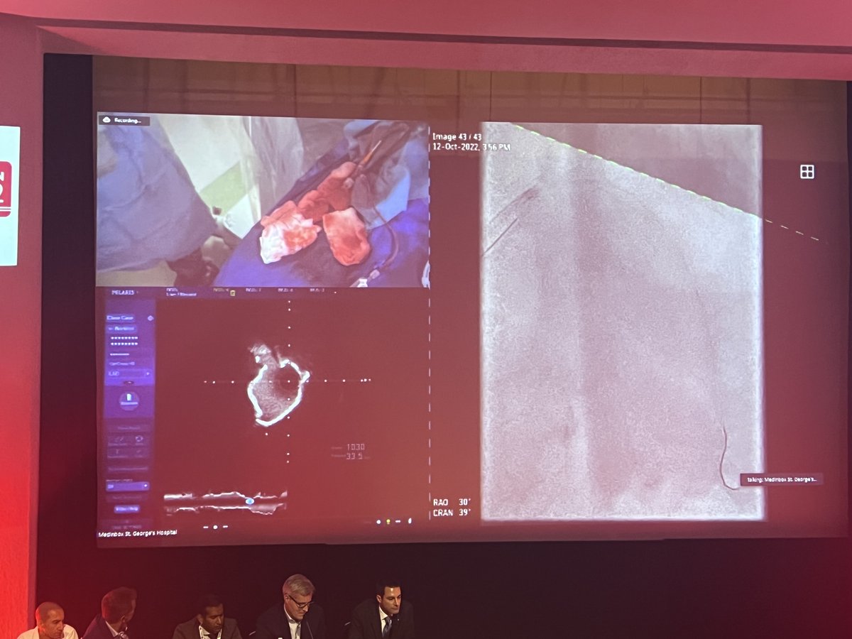 ShockwaveIVL's tweet image. #OPTIMALPCI2022 is off to a brilliant start with this live case by Drs @mbmcentegart @simonjwilson1 @jdinaus utilizing #ShockwaveIVL! Nice #RotaShock strategy with CT planning by Dr @ColletCarlos to evaluate Ca++ in #LAD before procedure.

ISI bit.ly/3iEq7fC @OptimaCTO