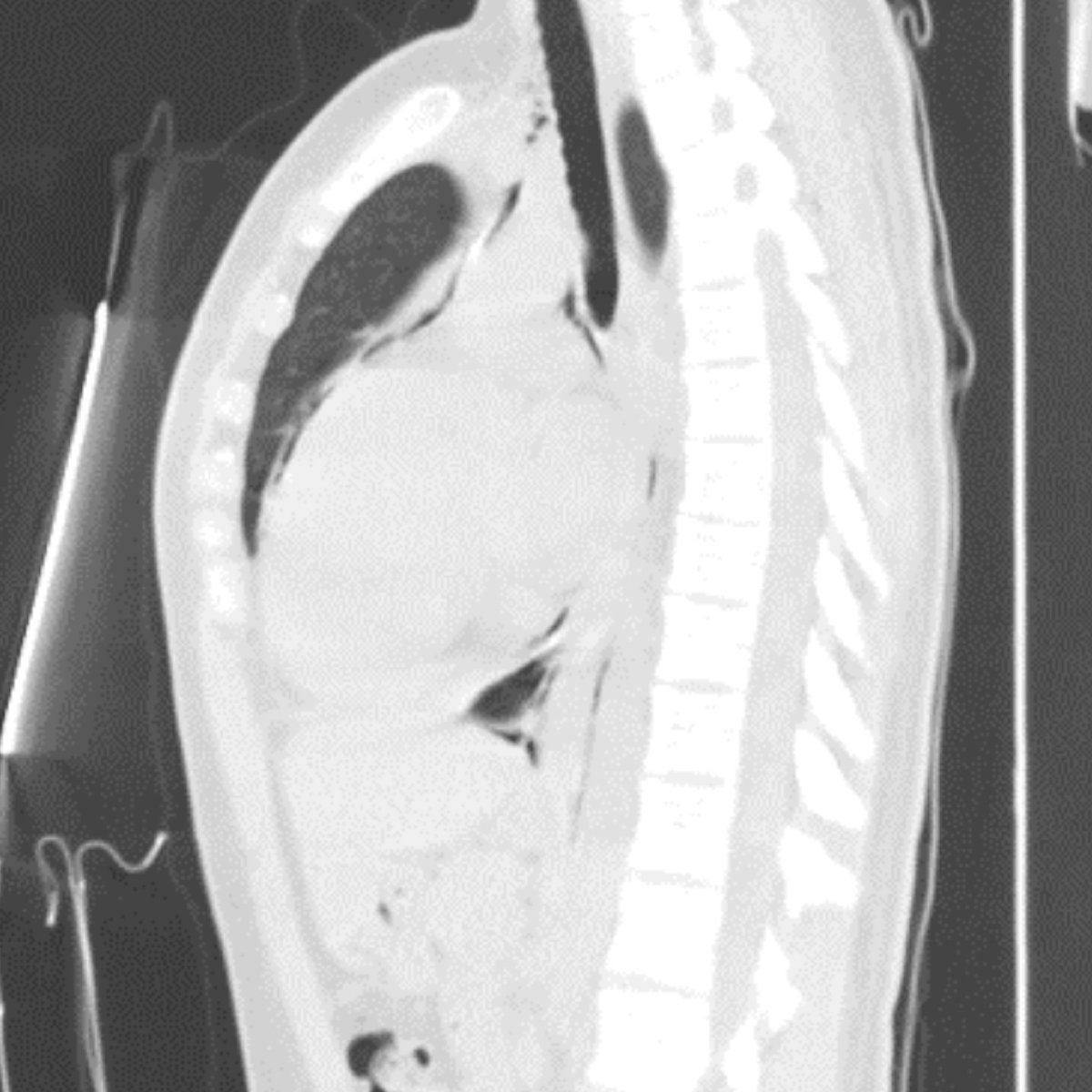 Check out this month's Thoracic Case of the Month!

20-year-old female with history of anxiety, presenting with substernal chest pain… submitted by Drs. @AWSongMD &amp; Joseph Lowry from <a href="/SIUHOSPITAL/">SIUH</a>.

thoracicrad.org/assets/index/2…