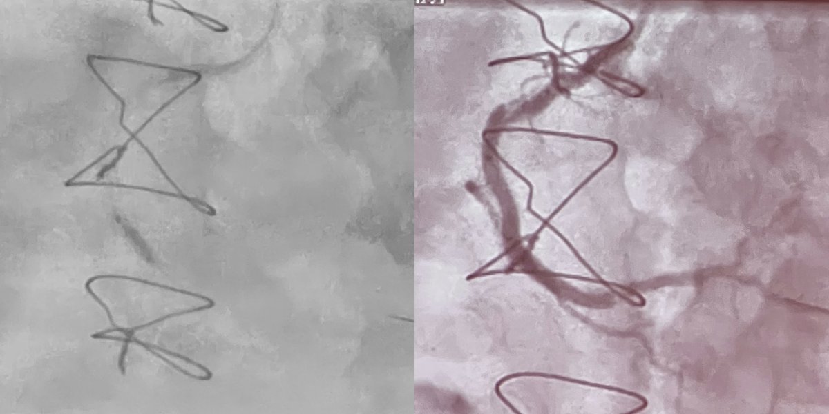 ShockwaveIVL's tweet image. Another great #RotaShock live case at #OPTIMALPCI2022 performed by Dr. @JoostDaemen from Thoraxcenter at Erasmus Medical Center @erasmusmcintl in Rotterdam. Excellent result!

ISI bit.ly/3iEq7fC @OptimaCTO #ShockwaveIVL