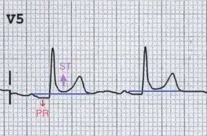 PR depression is the most specific ECG marker for pericarditis.