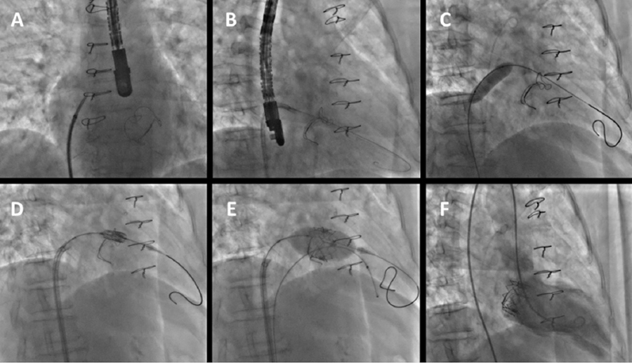 RaciRevista's tweet photo. Seguimiento de paciente con reemplazo percutáneo
de válvula #mitral protésica degenerada por vía transeptal. Primer caso en Argentina.Follow-up of a patient with percutaneous replacement of a
degenerated prosthetic mitral valve via the transseptal route. First case in Argentina. https://t.co/TK69Ddains