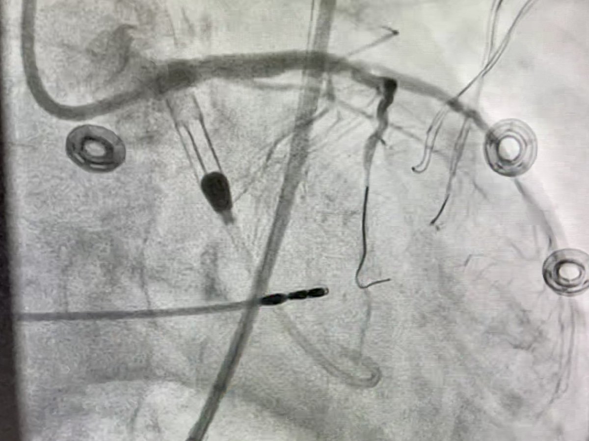 RajTayalMD's tweet image. Then went #PercAx for heavily calcified LM in cardiogenic shock after we were unable to get catheters up from right and left radial, right femoral…and finding this gem in the left iliac