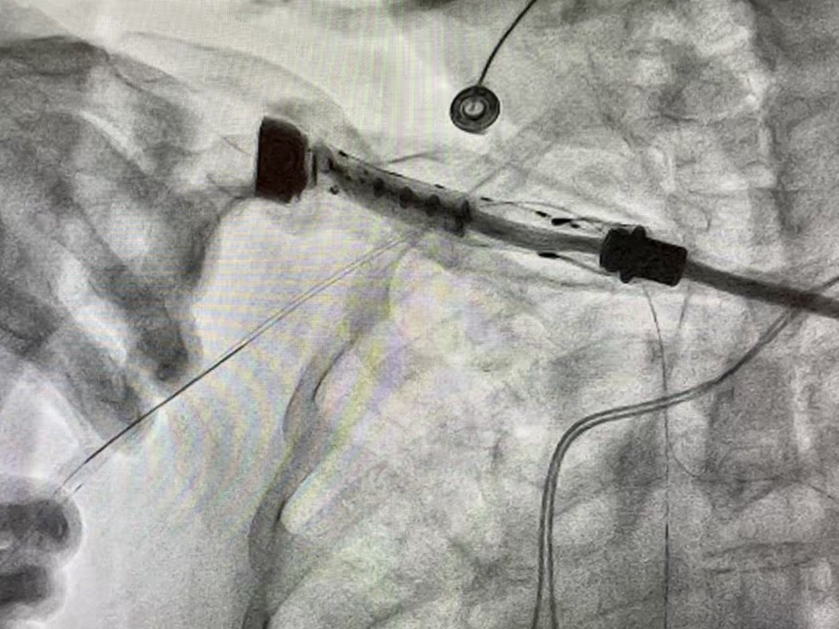 RajTayalMD's tweet image. Then went #PercAx for heavily calcified LM in cardiogenic shock after we were unable to get catheters up from right and left radial, right femoral…and finding this gem in the left iliac