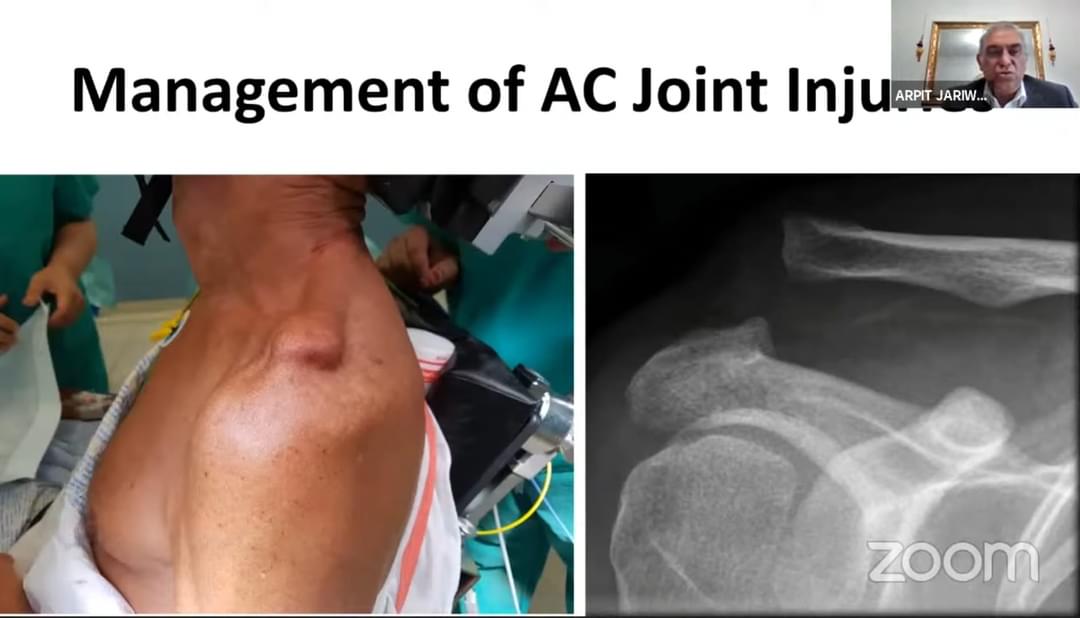 drhiteshg's tweet photo. https://t.co/uqzNroaQQ5
AC Joint Dislocations
#orthotwitter #orthopaedicprinciples #frcsorth #efort #aaos #secot #sofcot #isakos https://t.co/FJeYMxtFtF