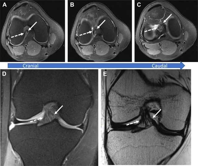 #Postoperative Magnetic Resonance Imaging of the #Knee #Ligaments By Saeed Dianat and Jenny T. Bencardino @jennybencardino 👏🏼 #SERME #MSKRad #MRI sciencedirect.com/science/articl…