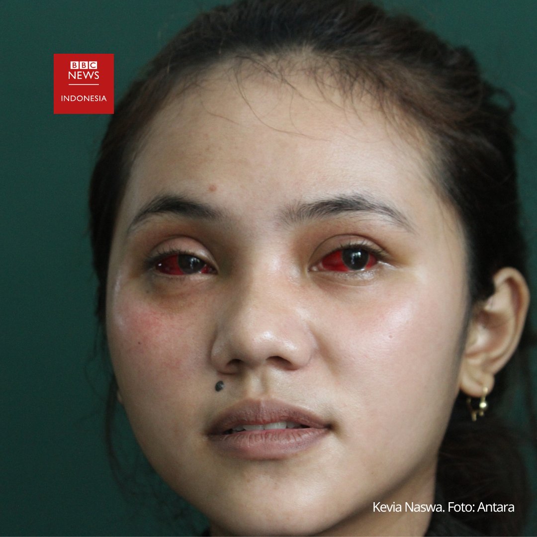 BBCIndonesia's tweet photo. Ini adalah kondisi mata Kevia Naswa pada Rabu, 12 Oktober 2022. Dia adalah 1 dari 737 korban luka dalam Tragedi Kanjuruhan.

Sementara itu, pihak-pihak terkait dinilai saling melempar tanggung jawab. https://t.co/zBZ0GpY5Yi https://t.co/MyAALgkNsy
