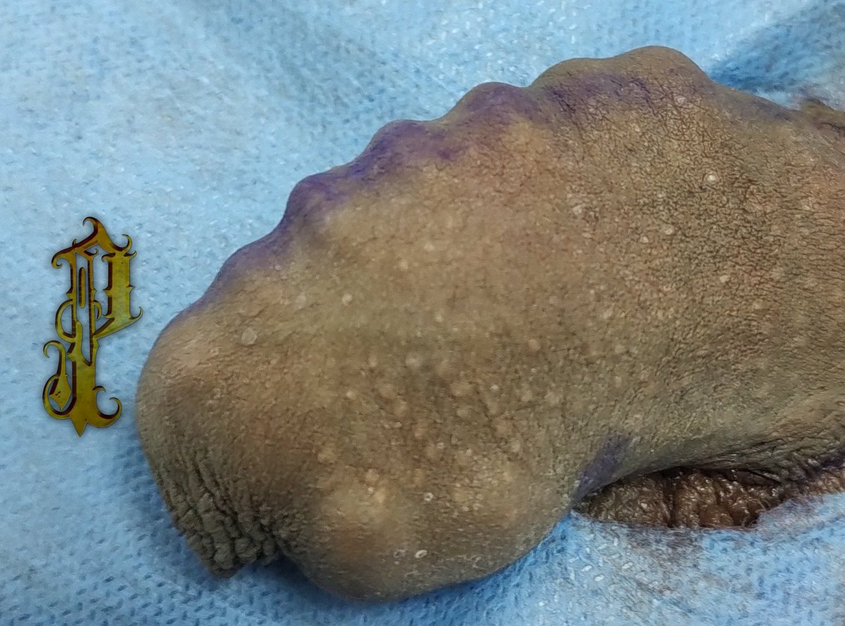 PlagaMiranda's tweet photo. Implantes genitales recién colocados , en este caso en la parte superior e inferior del miembro con dos piezasde diferente dimensión !!!!
Recuerda que los superhéroes si existen!!!! https://t.co/P4EHiUCDKk