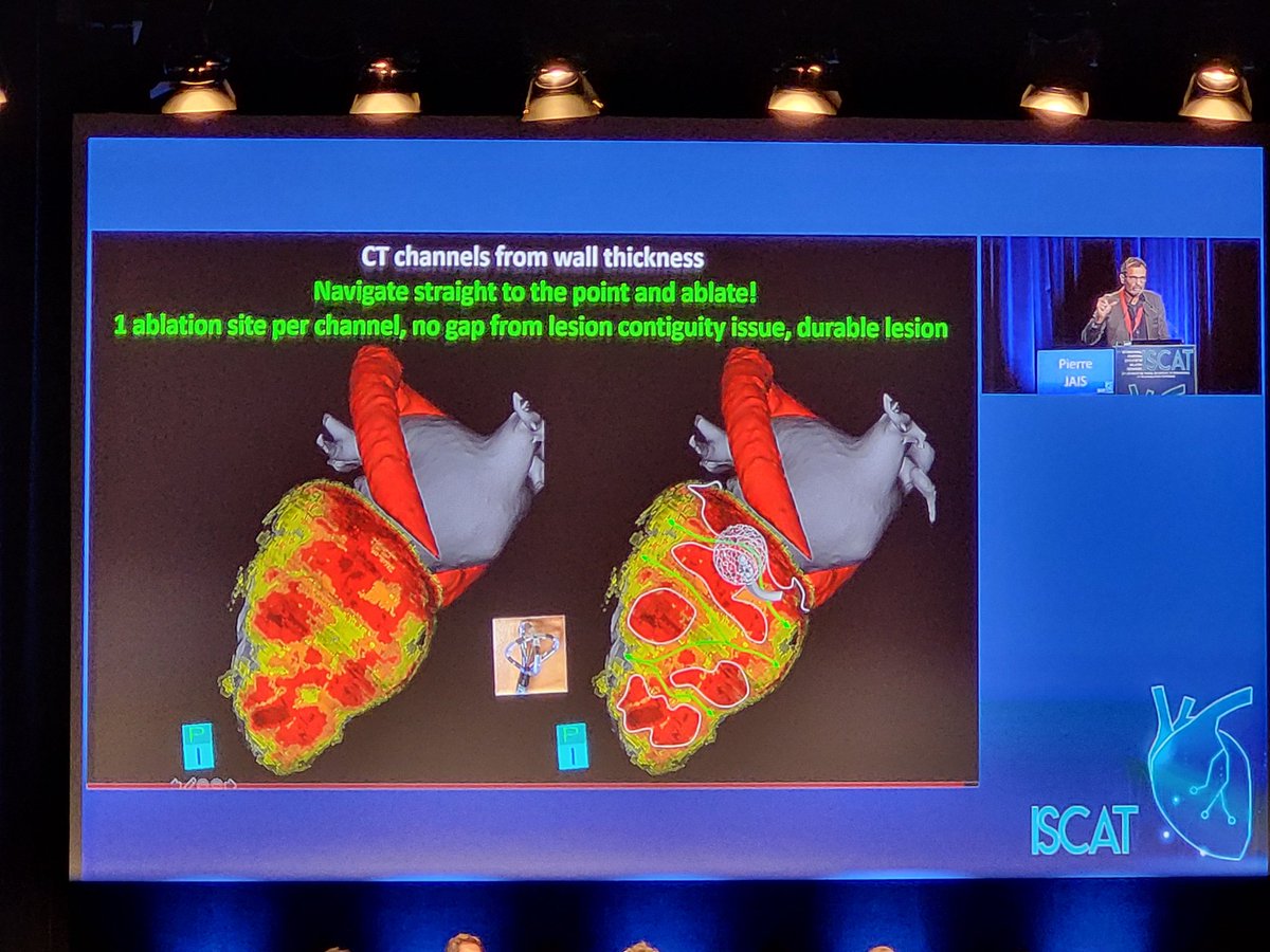 rythmo_sfc's tweet photo. 1️⃣Cartographie non-invasive par l'imagerie
2️⃣Ablation par PFA ciblant les isthmes potentiels
▶️Le futur de l'ablation de TV❓️
Par Pierre Jais, #ISCAT2022 https://t.co/LEphalwG2s
