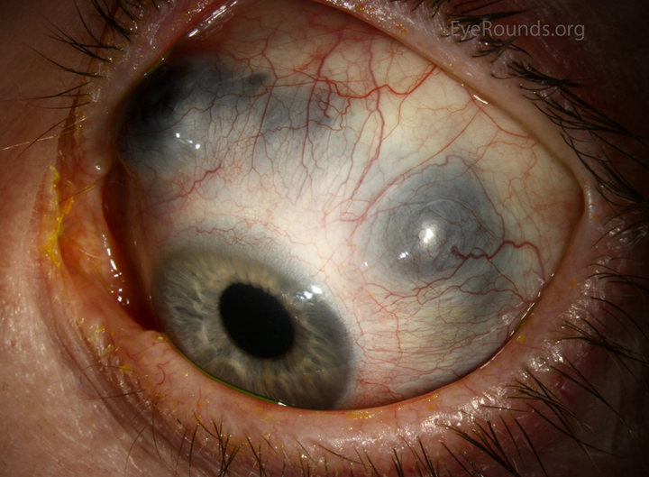 marrow_med's tweet photo. A 48-yr-old woman with pain &amp; stiffness in her hands &amp; wrists, worse in morning for past few years. Presents with c/o irritation &amp; photophobia in her left eye. O/E, swelling in wrists, MCP &amp; PIP joints,ocular finding👇🏼 Name this finding &amp; associated condition?
#MedTwitter #MedEd https://t.co/oVWpJZzOw7