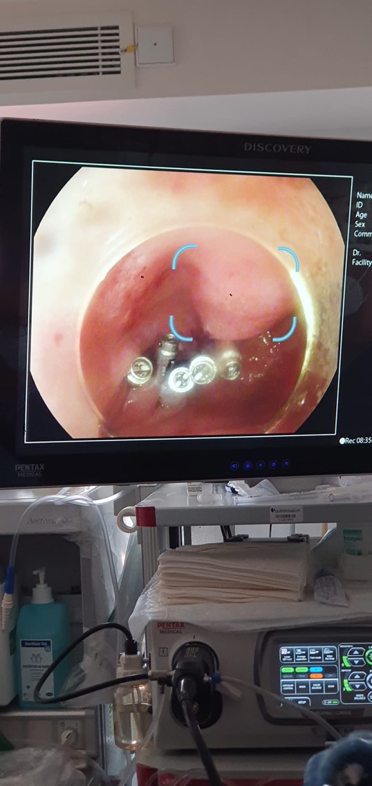 STEndoscopia's tweet photo. Nuestro equipo dio lo mejor de sí en las Jornadas de Endoscopia Avanzada que se celebraron con una gran asistencia de profesionales y excelentes conferencias y casos en directo.
¡Deseando que llegue ya la próxima edición! 🚀🚀
#STEndoscopia #gastroenterology #endoscopy https://t.co/7Bzx6cHiV9
