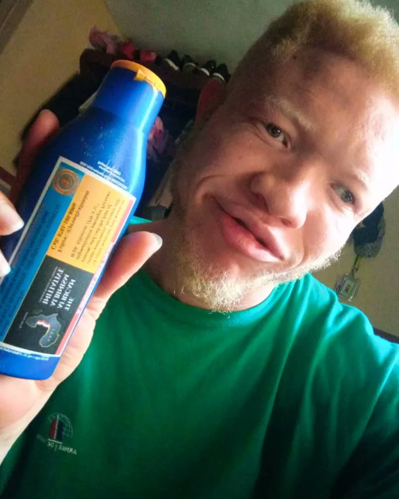 ProudlyAlbinism's tweet photo. From Jos in Nigeria, Xtopher Khypo Jr. acknowledged receiving our package. Proudly sponsored by Human Race Diagnostic and Specialist Huspital. 

Please kindly support our charity work to persons with albinism. Contact us via 07011008096

#ThinkPositive 
#ProudlyAlbinism 
#TAAI https://t.co/D25HOiKJSO