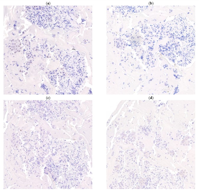 JMP_MDPI's tweet photo. π’New published paper ''Comparison of #GATA3, #GCDFP15, #Mammaglobin and #SOX10 #Immunocytochemistry in Aspirates of Metastatic #Breast Cancer''π
πEnjoy reading: https://t.co/U4STI3a3ZG
πSI information: https://t.co/tTlO6vC86x
#aspiration_cytology #metastatic_breast_cancer https://t.co/ECmjPq8vM5