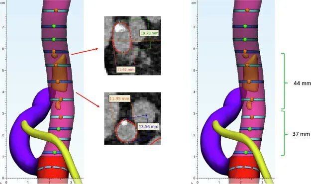 EUplatinum's tweet photo. New Surgery in Motion: Three-dimensional Augmented Reality–guided Robotic-assisted Kidney Transplantation: Breaking the Limit of Atheromatic Plaques 

https://t.co/28BYQ09cxs 

#surgeryinmotion #urology #medtwitter #roboticsurgery https://t.co/DlbqARowHo