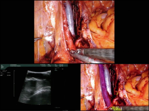 EUplatinum's tweet photo. New Surgery in Motion: Three-dimensional Augmented Reality–guided Robotic-assisted Kidney Transplantation: Breaking the Limit of Atheromatic Plaques 

https://t.co/28BYQ09cxs 

#surgeryinmotion #urology #medtwitter #roboticsurgery https://t.co/DlbqARowHo