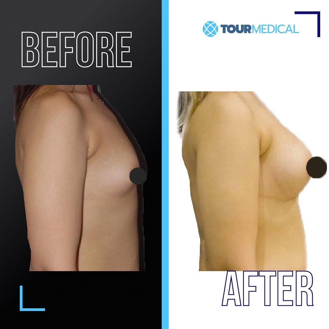 Tourmedical's tweet photo. Have ideal breast sizes with breast aesthetics, which is one of the most preferred aesthetic operations in the world! Contact Tour Medical for detailed information about this operation, which allows the breasts to be enlarged or reduced by intervening in the breast structure. https://t.co/pYemIQrChp
