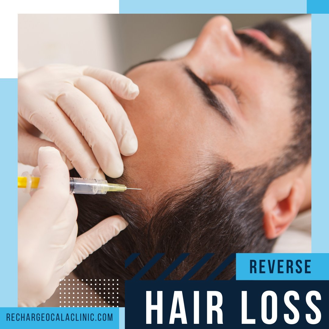 Stop using products from over the counter that promises to regrow hair. PRP injections are a proven way to reverse balding; best of all, it's 100% natural. Stop in for a free consultation and see how we can help!

#ocala #rechargeclinic #hairloss #balding #prp #hairgoal #ladylake