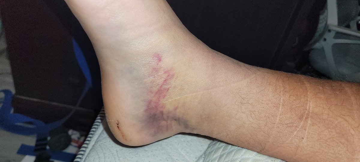AustinP7761406's tweet photo. a sliver of hope received at the ortho. with a little luck and a lot of work...there is a chance I can return to the field for sectionals

#77apaul #fortheloveoffootball #VarsityFootball #varsity #OLineproblems #lineman https://t.co/LykwEZkPZf