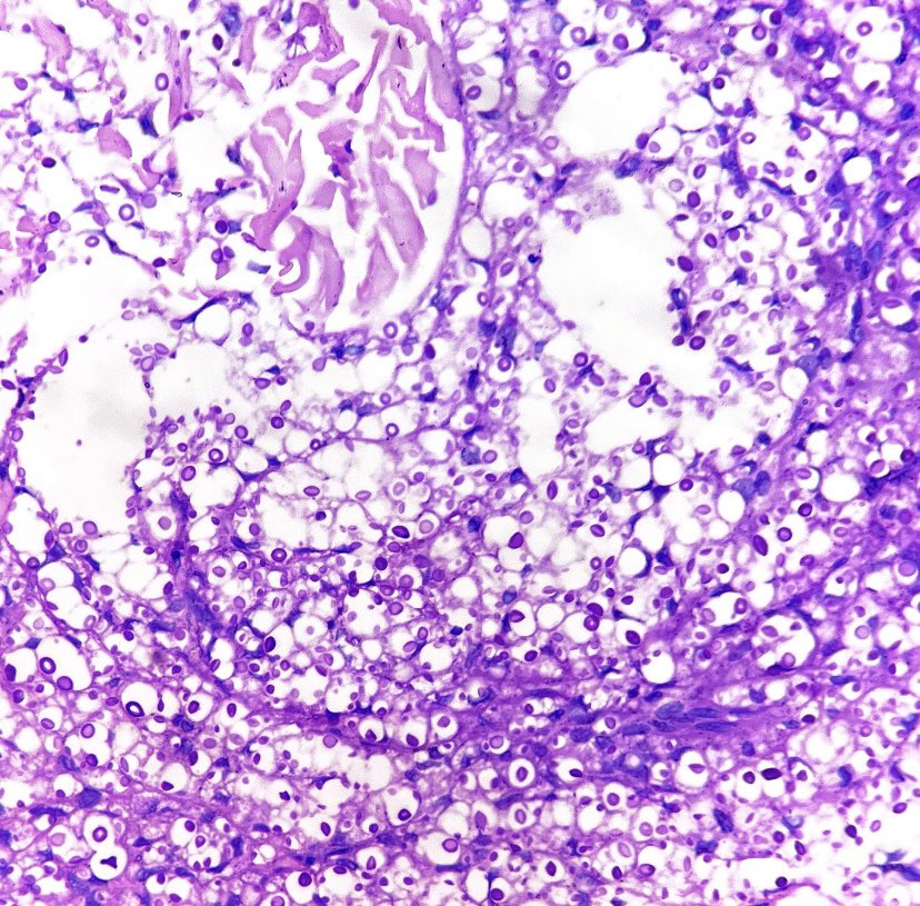 Relapsing-remitting necrotic papules in an HIV+ patient=
Cryptococcosis (gelatinous reaction)!
-Little inflammation
-Mucoid tissue degeneration
-Small yeasts 4-20um
-PAS GMS mucicarmine +
-Sometime has granulomatous reaction
#PathTwitter #dermpath #pathology #dermtwitter