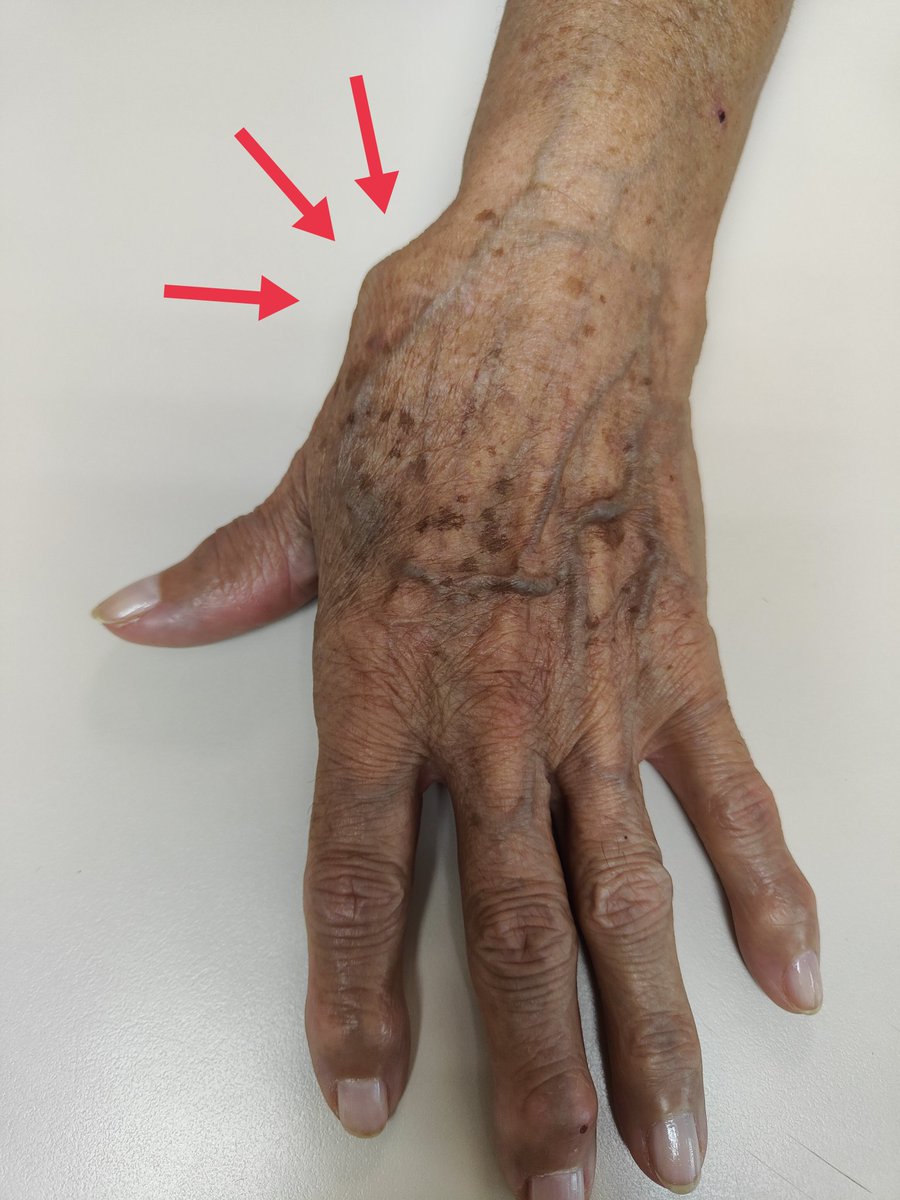 Signo del hombro, es artrosis avanzada hasta que se demuestre lo contrario