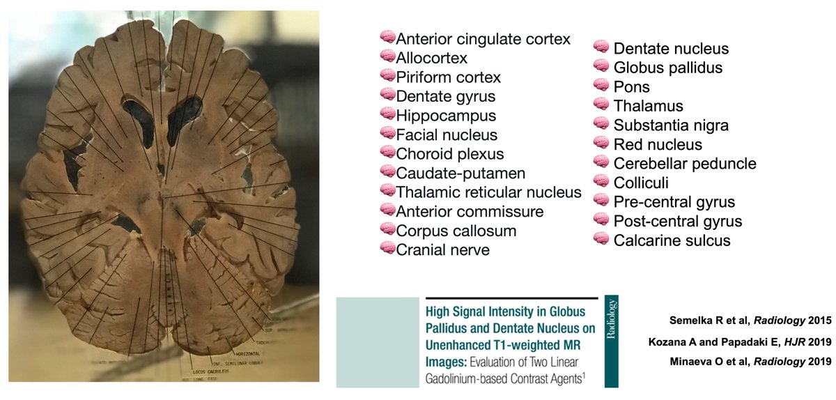 Wagner_Nephro's tweet photo. Veterans with Gulf War illness have atrophy in:
🧠 Brainstem
🧠 Ventral diencephalon
🧠 Thalamus

#GulfWar
#ChronicIllness
#Multisymptom
#Fatigue 

Muscle/joint pains
Memory/concentration problems
Headaches

Brainstem atrophy in Gulf War Illness,
https://t.co/LE7Dk0Fir9 https://t.co/Lw4xdjGTQO