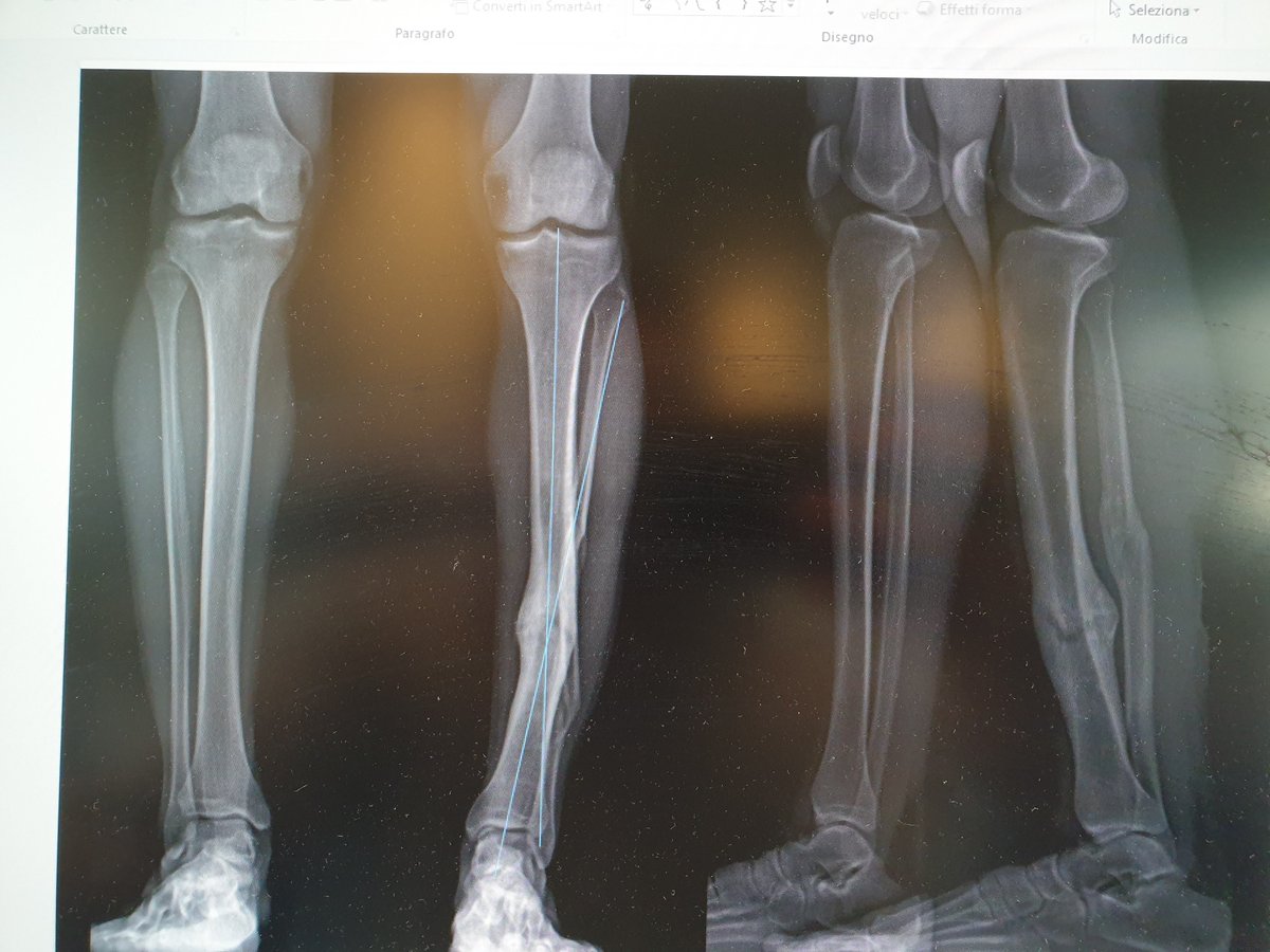 Post traumatic varus deformity, correction by #Ilizarov osteotomy rule number 2