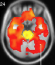 Prabesh Kanel has a new paper out on cholinergic losses in PSP compared to Parkinson. Check it out:
pubmed.ncbi.nlm.nih.gov/36222971/ Differential PD vs PSP cholinergic vulnerability well extends beyond the tectum