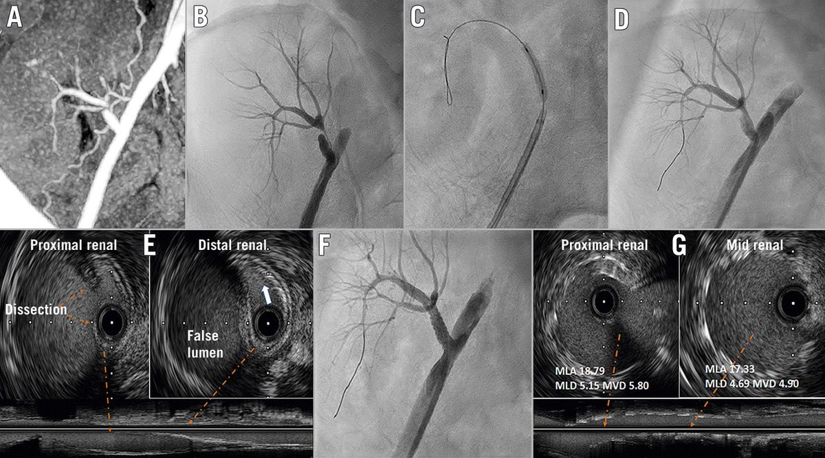 AsiaInterv's tweet image. 👋#cardiotwitter the🆕issue of #AsiaIntervention is out! Read about: 
➡️an expert consensus on LV devices during PCI
➡️a review on coronary physiology in the #cathlab
➡️TricValve for resistant🫀failure with TR
➡️PCI in octogenarians
and much more!
🖱️bit.ly/3RJa8eg