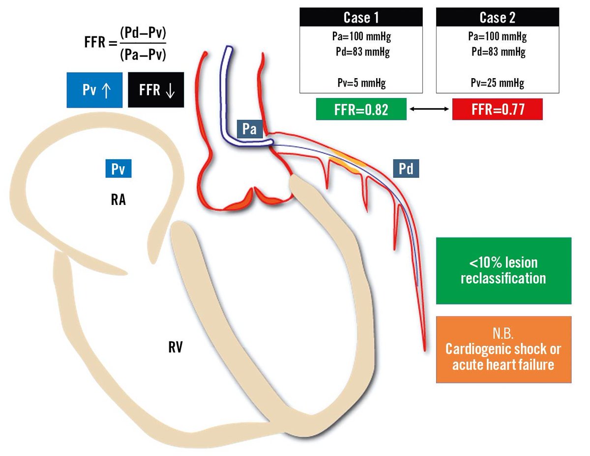 AsiaInterv's tweet image. 👋#cardiotwitter the🆕issue of #AsiaIntervention is out! Read about: 
➡️an expert consensus on LV devices during PCI
➡️a review on coronary physiology in the #cathlab
➡️TricValve for resistant🫀failure with TR
➡️PCI in octogenarians
and much more!
🖱️bit.ly/3RJa8eg