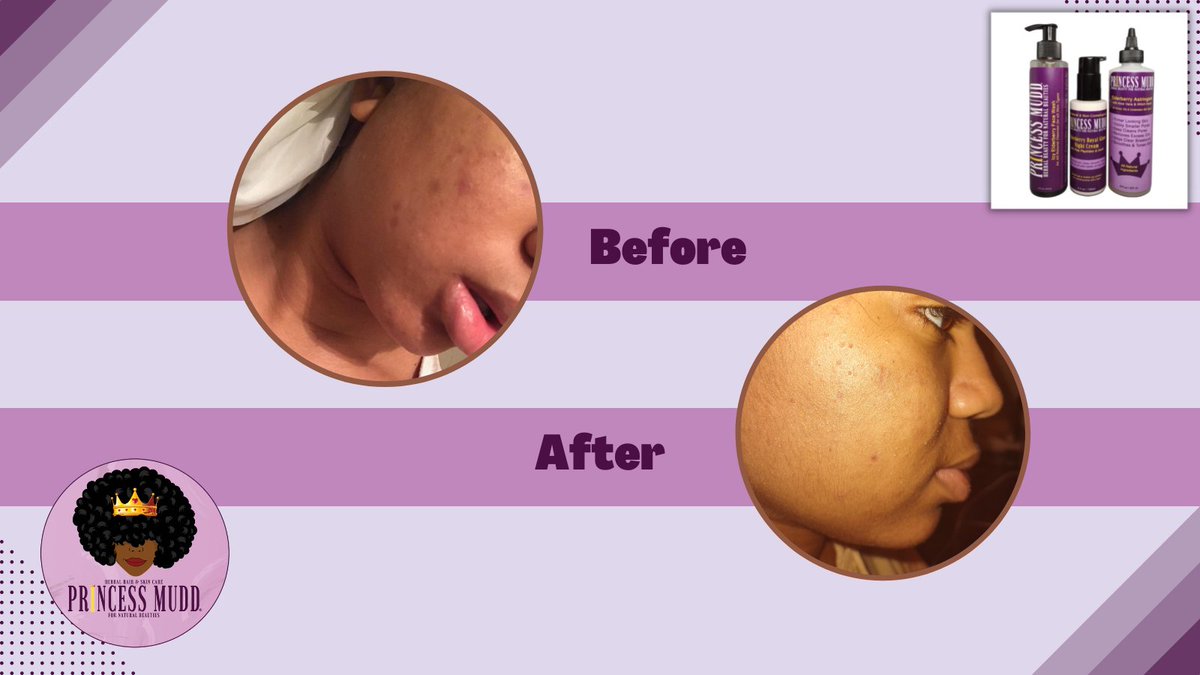 ThePrincessMudd's tweet photo. Results. #skincare #beforeafter #princessmudd #weroyal https://t.co/JO7U4eRKwd