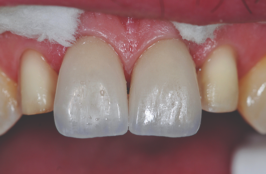 InDentalTech's tweet photo. In case you missed it! #MasterClassFlashback: “Treating Traumatic Oral Injury: A Personal Account” by Kyle Swan, CDT https://t.co/D97XWoxgBY https://t.co/djHygpAinI