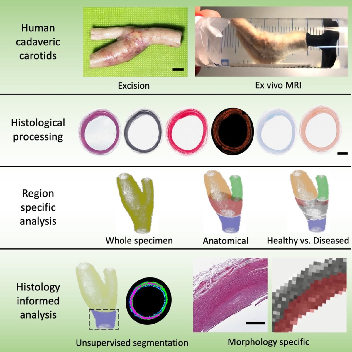 ATVB: An AHA Journal (@atvbahajournals) on Twitter photo his study highlights microstructural and morphological sensitivities ofdiffusion tensor imaging in human cadaveric carotid arteries
<a href="/btornifoglio/">Brooke Tornifoglio</a> <a href="/TrionaLally/">Tríona Lally</a> ahajrnls.org/3TjJQk5 his study highlights microstructural and morphological sensitivities ofdiffusion tensor imaging in human cadaveric carotid arteries
<a href="/btornifoglio/">Brooke Tornifoglio</a> <a href="/TrionaLally/">Tríona Lally</a> ahajrnls.org/3TjJQk5