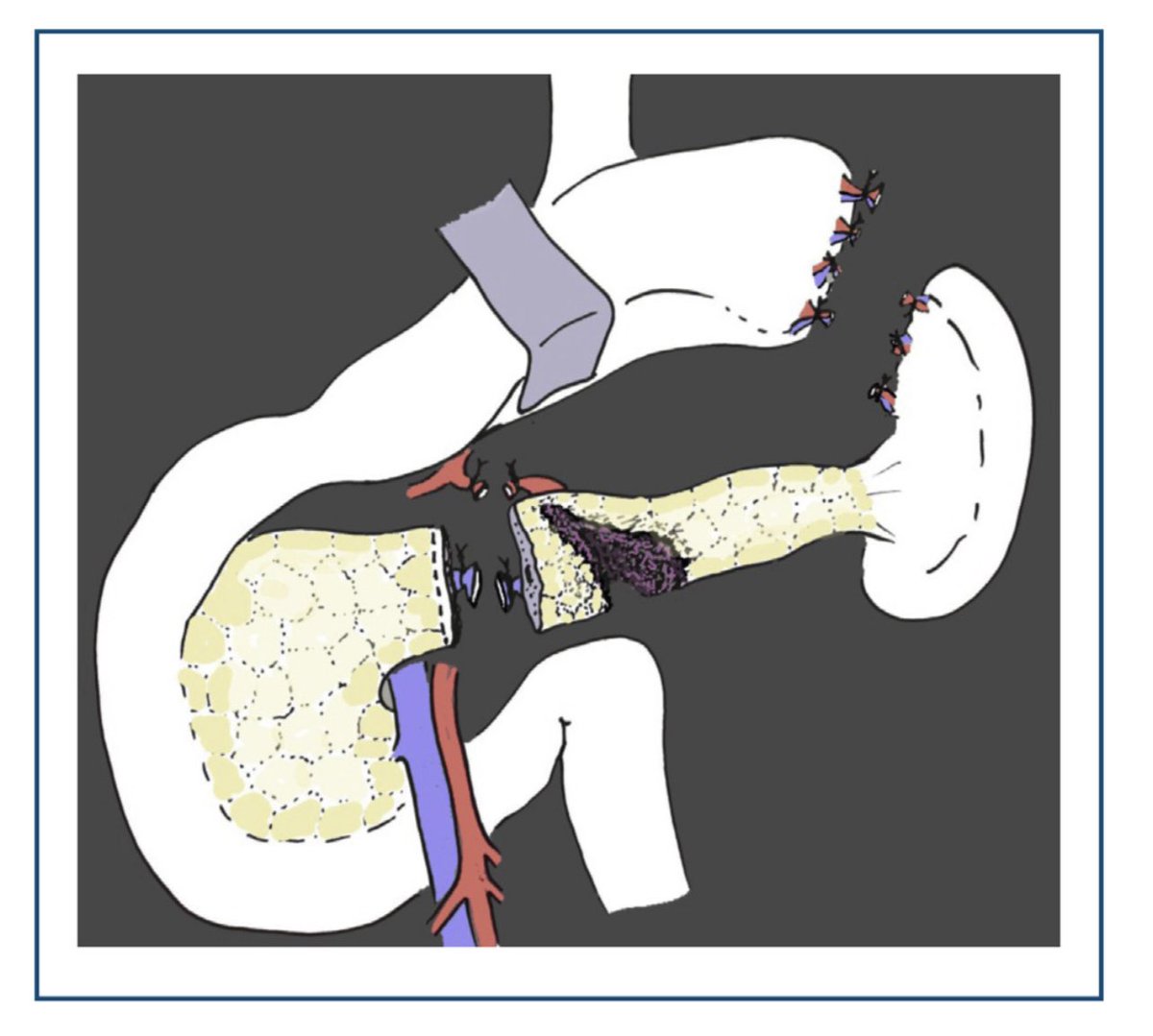Cirbosque SoMe4Surgery on Twitter "Pancreatic trauma surgical options