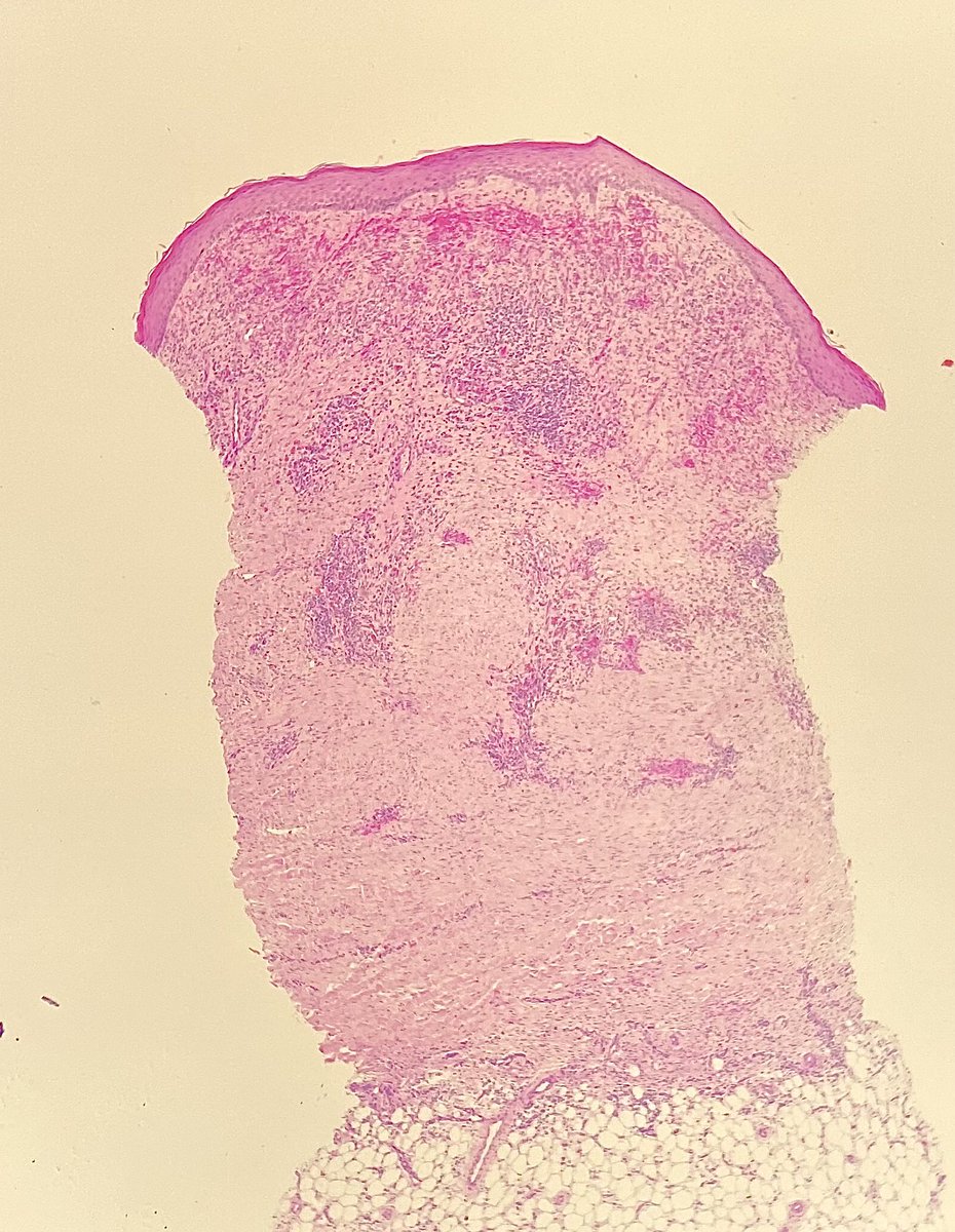 Nate_path's tweet photo. HHV8 pending…or need I bother? #dempath #PathTwitter https://t.co/E8Er2oKc6A