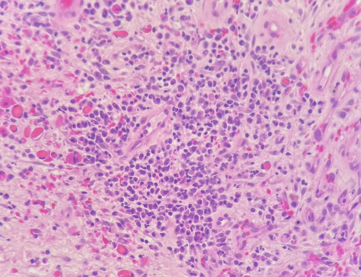 Nate_path's tweet photo. HHV8 pending…or need I bother? #dempath #PathTwitter https://t.co/E8Er2oKc6A