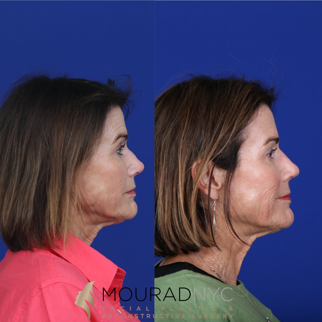 NYCFaceDoc's tweet photo. Your nose is your signature, so why not give it a boost and enhance your features? https://t.co/kI43zqirQZ