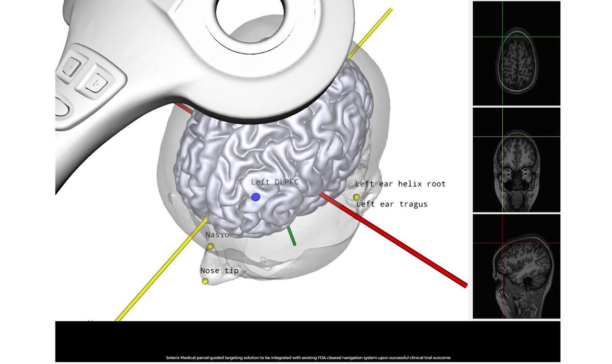 Soterix Medical Announces award of Fast Track NIH grant to develop a Parcel-Guided software to improve efficacy of rTMS treatment for #depression   prn.to/3TieQ3V Learn about Navigated rTMS for Depression:bit.ly/3g5vjKA &amp; navigation: bit.ly/3T15jOZ