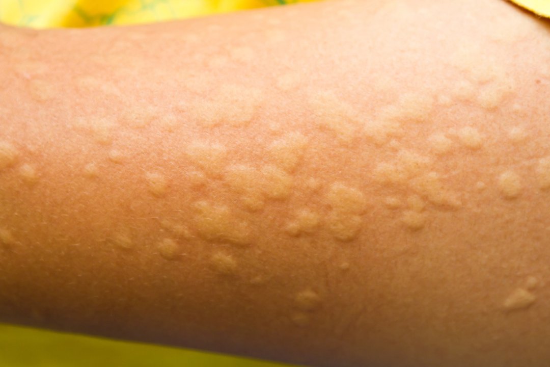 AADmember's tweet photo. An @actadv study included 2-year follow up of patients with chronic #urticaria that failed treatment with 4 times the recommended antihistamine dosage. Learn more in #DermWorldWeekly - https://t.co/ObWxImFczy https://t.co/fHrYsKBNgE