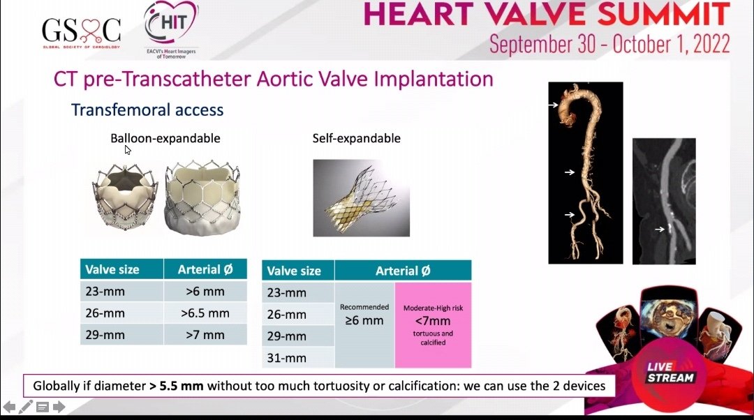 drmilicaa's tweet image. #whyCCT before #TAVI
Excellent explanation by @PezelT

@GSoCers @iyacpeople @saskavaska @N_cardiologist @VDelgadoGarcia @alessia_gimelli @NMerke @dr_maghraby @KemalogluOz @JasonKatzMD @ZainabDakhil2 @aayshacader @mirvatalasnag @alexsfelixecho