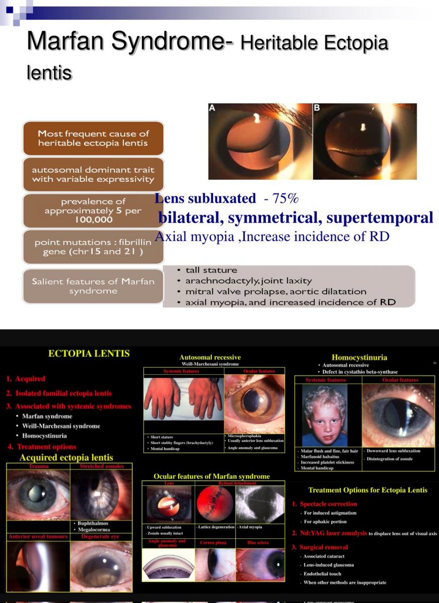 Sthanu on Twitter "Marfan’s Clinically, ectopia lentis is bilateral in