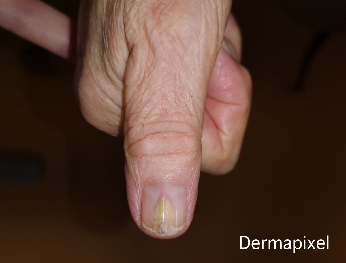 Esta semana <a href="/dermapixel/">Dermapixel</a> se pone de #uñas, gracias a un casito de <a href="/JuanJCauhe/">Juan Jiménez Cauhé</a> 
dermapixel.com/2022/10/una-un…
#dermatología #dermtwitter