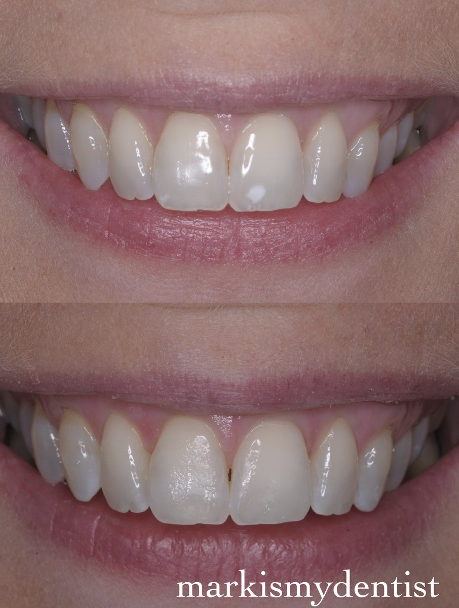 Great result with #icon. White opacities on teeth can be treated with #Icon micro infiltration system. No anaesthetic, painless, non-invasive treatment. Can be used to treat white spots caused by #fluorosis #trauma #demineralisation contact <a href="/Dentisthale/">Crescent Dental Care</a> for details