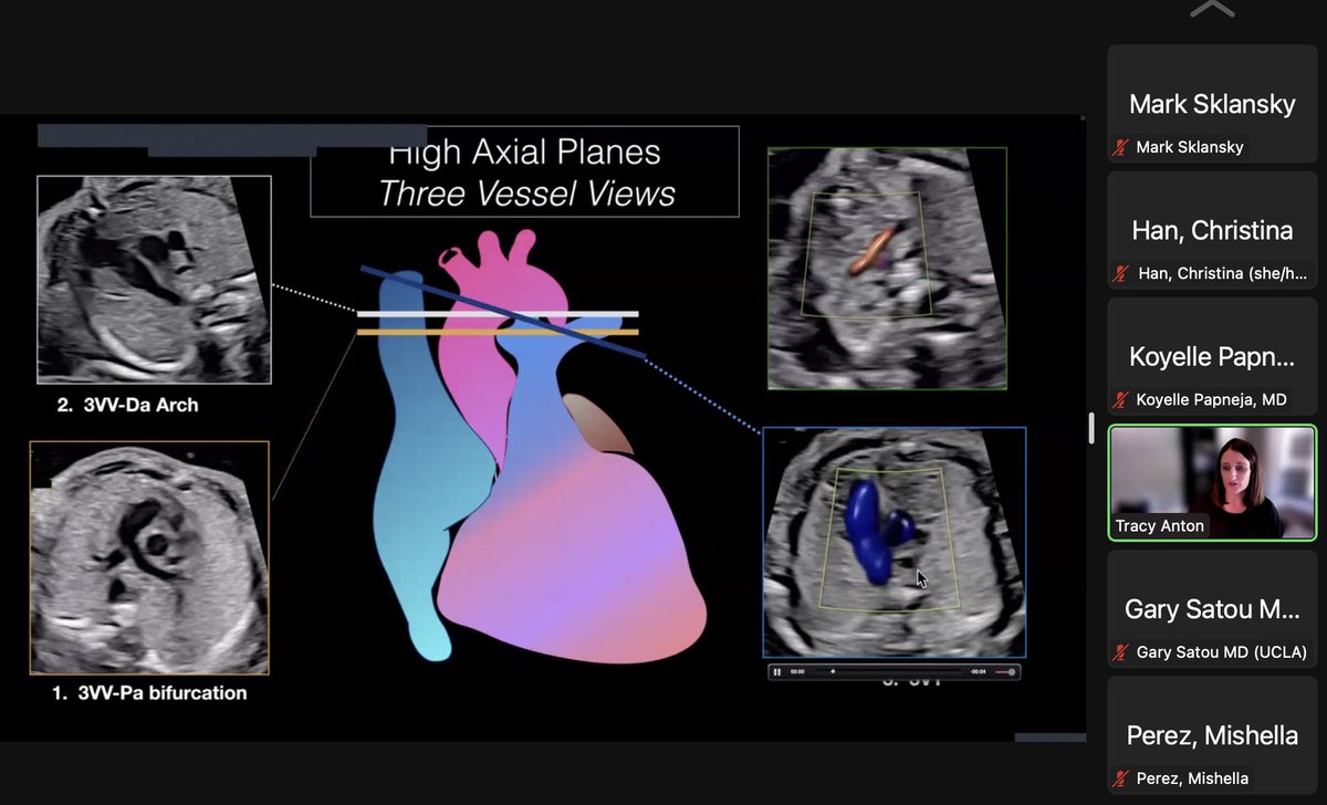 ChrisHanMFM's tweet photo. @tracy_anton1 talking about one of the most important planes in #fetalecho!
#UCLAFetalEcho2022 #3VV #3VT @msklansky @MishellaPerez @uclaobgynedu @UCSD_ObGyn #CME https://t.co/uQfqeryecF