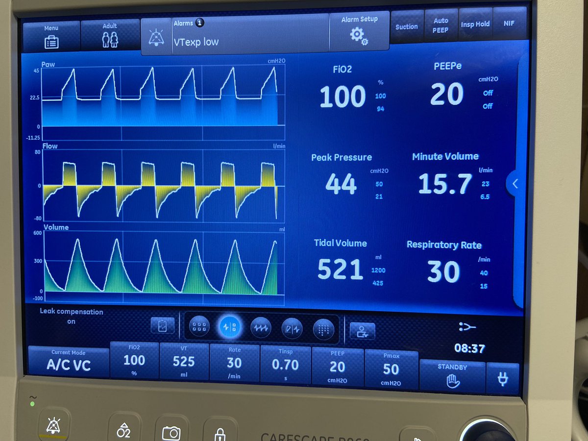 🧵 Cool Vent Findings!! 🧵 

You have a very hypoxic patient on the following settings with the waveforms as shown: