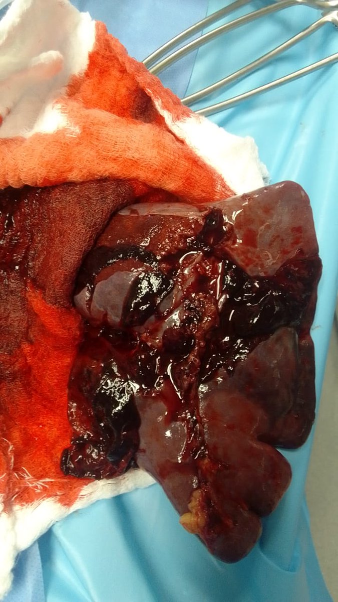 Asiritrauma1's tweet photo. Spleen
RTC arrived in shock
ShockTOR protocol
#TraumaOne #MajorTraumaCenter https://t.co/wg5e6QHWri