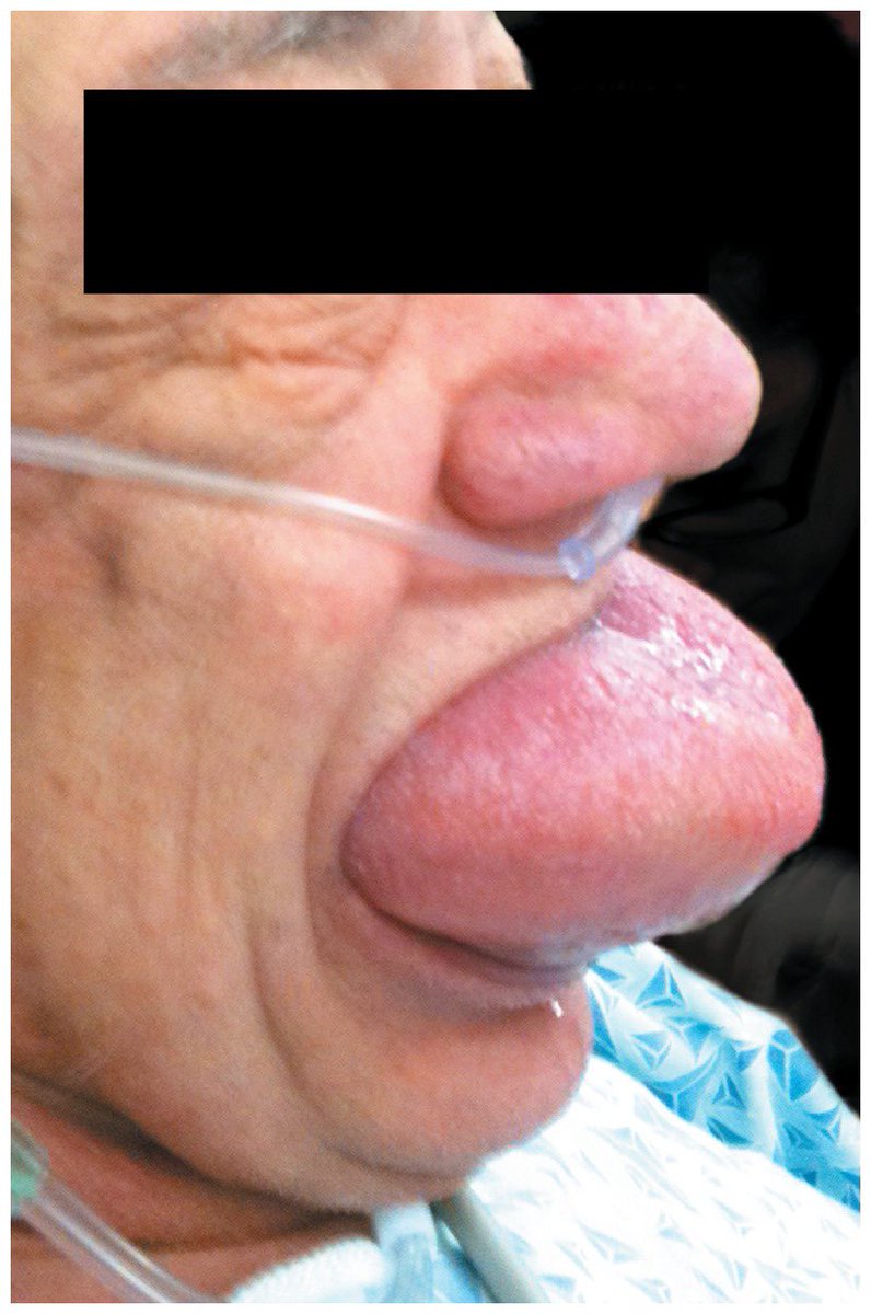AvrahamCooperMD's tweet photo. This is the largest tongue I’ve ever seen (angioedema) 🤯

#MedTwitter https://t.co/AQfRpTQUDd